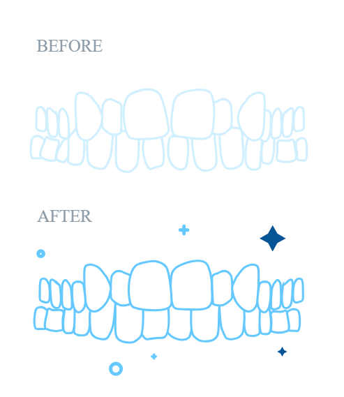 Invisalign illustration